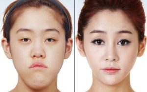 Операция на лицо в Корее