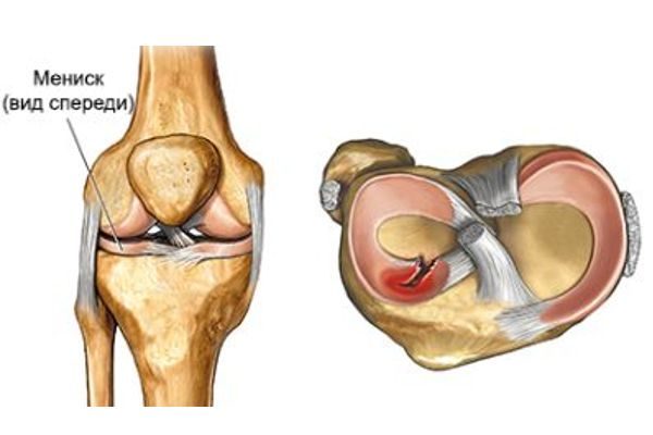 Уникальный имплантат для восстановления поврежденного мениска в колене