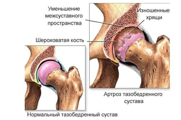 Лечение коксартроза тазобедренного сустава в корее