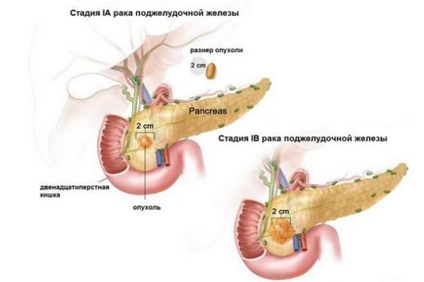 Лечение в корее рака поджелудочной железы
