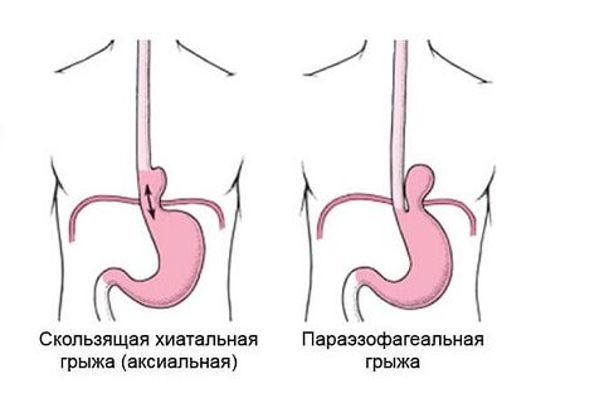 Взаимосвязь между заболеваниями позвоночника, кишечника и прямой кишки