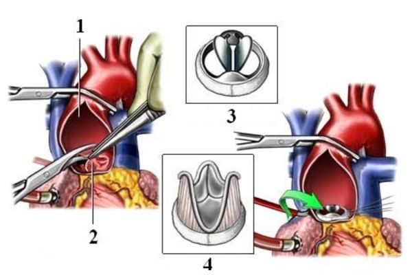 Митральный клапан после операции. Операции на аортальном клапане. Хирургическое протезирование аортального клапана. Митральный и аортальный клапан сердца. Сердце операция митральный клапан.