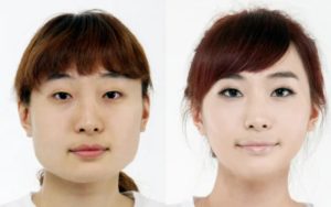 Контурная пластика лица в Корее